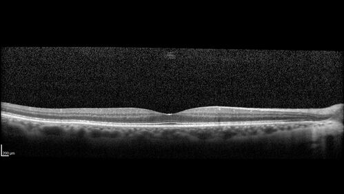 Branch retinal vein occlusion with macular edema
71 year old man Starting about 2 weeks ago the left eye was blurred.  The right eye is seeing well. 
VA OD: sc20/25+2 NccJ1+
VA OS: sc20/63+2 PH20/50-2 Ncc20/400
IOP: TP: OD:19 OS:16

