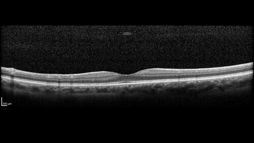 Branch retinal vein occlusion with macular edema
71 year old man Starting about 2 weeks ago the left eye was blurred.  The right eye is seeing well. 
VA OD: sc20/25+2 NccJ1+
VA OS: sc20/63+2 PH20/50-2 Ncc20/400
IOP: TP: OD:19 OS:16

