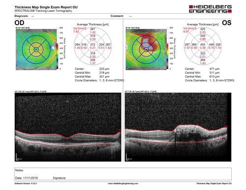 Branch retinal vein occlusion with macular edema
71 year old man Starting about 2 weeks ago the left eye was blurred.  The right eye is seeing well. 
VA OD: sc20/25+2 NccJ1+
VA OS: sc20/63+2 PH20/50-2 Ncc20/400
IOP: TP: OD:19 OS:16
