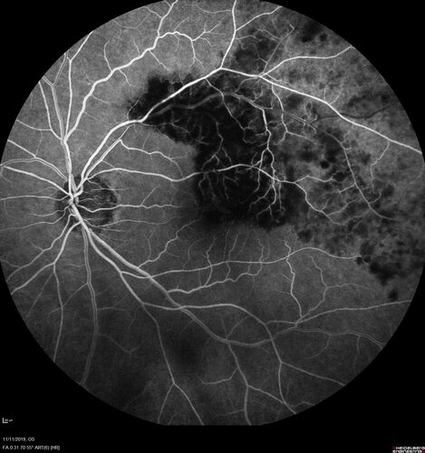 Branch retinal vein occlusion with macular edema
71 year old man Starting about 2 weeks ago the left eye was blurred.  The right eye is seeing well. 
VA OD: sc20/25+2 NccJ1+
VA OS: sc20/63+2 PH20/50-2 Ncc20/400
IOP: TP: OD:19 OS:16
