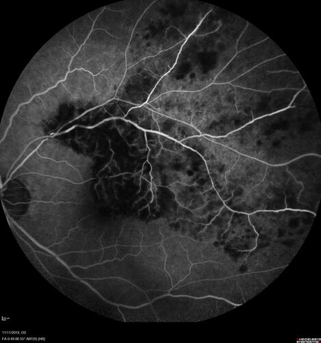 Branch retinal vein occlusion with macular edema
71 year old man Starting about 2 weeks ago the left eye was blurred.  The right eye is seeing well. 
VA OD: sc20/25+2 NccJ1+
VA OS: sc20/63+2 PH20/50-2 Ncc20/400
IOP: TP: OD:19 OS:16
