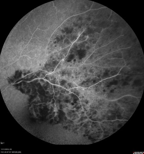 Branch retinal vein occlusion with macular edema
71 year old man Starting about 2 weeks ago the left eye was blurred.  The right eye is seeing well. 
VA OD: sc20/25+2 NccJ1+
VA OS: sc20/63+2 PH20/50-2 Ncc20/400
IOP: TP: OD:19 OS:16
