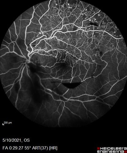 Branch Retinal Vein Occlusion with Neovascularization Elsewhere and Vitreous Hemorrhage
57 year old man New floaters in the left eye about a month ago.  Now they are getting better.  PMHx A-Fib on Pradaxa
VA 20/32 OD, 20/40 OS
1+ NS OU
BP 137/77, 200LBs, 5â€™8â€

PRP laser was done
