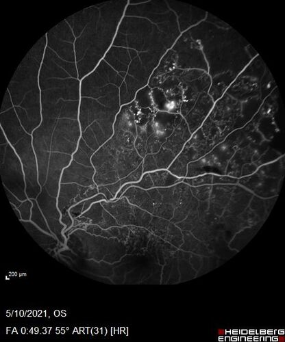 Branch Retinal Vein Occlusion with Neovascularization Elsewhere and Vitreous Hemorrhage
57 year old man New floaters in the left eye about a month ago.  Now they are getting better.  PMHx A-Fib on Pradaxa
VA 20/32 OD, 20/40 OS
1+ NS OU
BP 137/77, 200LBs, 5â€™8â€

PRP laser was done
