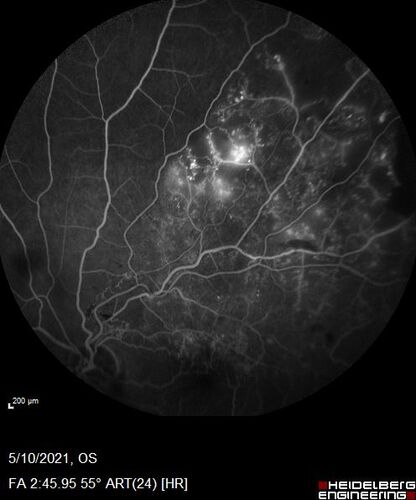 Branch Retinal Vein Occlusion with Neovascularization Elsewhere and Vitreous Hemorrhage
57 year old man New floaters in the left eye about a month ago.  Now they are getting better.  PMHx A-Fib on Pradaxa
VA 20/32 OD, 20/40 OS
1+ NS OU
BP 137/77, 200LBs, 5â€™8â€

PRP laser was done
