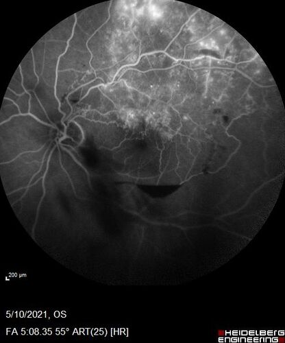 Branch Retinal Vein Occlusion with Neovascularization Elsewhere and Vitreous Hemorrhage
57 year old man New floaters in the left eye about a month ago.  Now they are getting better.  PMHx A-Fib on Pradaxa
VA 20/32 OD, 20/40 OS
1+ NS OU
BP 137/77, 200LBs, 5â€™8â€

PRP laser was done

