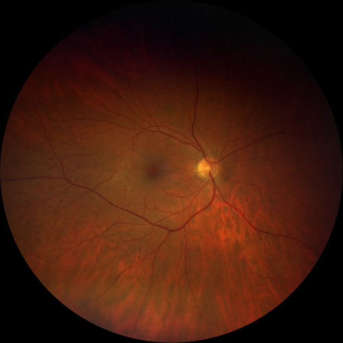 Acute Branch Retinal Vein Occlusion - 20/200
66 year old female with 3 weeks of vision loss in the left eye.  VA 20/20 OD 20/200 OS
