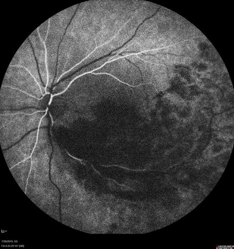 Acute Branch Retinal Vein Occlusion - 20/200
66 year old female with 3 weeks of vision loss in the left eye.  VA 20/20 OD 20/200 OS
