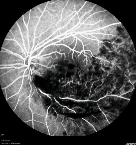Acute Branch Retinal Vein Occlusion - 20/200
66 year old female with 3 weeks of vision loss in the left eye.  VA 20/20 OD 20/200 OS
