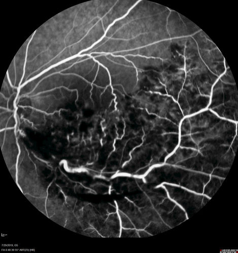 Acute Branch Retinal Vein Occlusion - 20/200
66 year old female with 3 weeks of vision loss in the left eye.  VA 20/20 OD 20/200 OS
