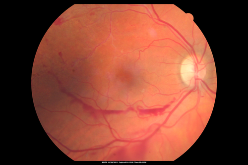Branch Retinal Vein Occlusion with NVE (Neovascularization Elsewhere)
