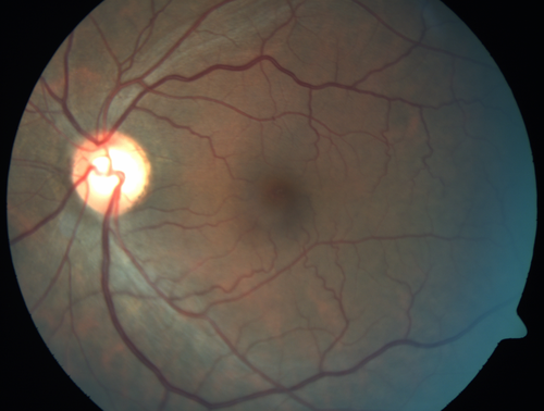 Normal Fellow Eye (Berlin's Edema)
