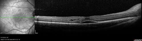 Neuroretinitis - NOT cat scratch - 5 year old
Presented with nerve swelling, serous RD and uveitis.  Ultimately responded to steroids and methotrexate.  ANA is positive.  All other extensive testing negative including MRI worried about MS
