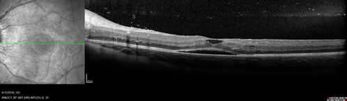 Neuroretinitis - NOT cat scratch - 5 year old
Presented with nerve swelling, serous RD and uveitis.  Ultimately responded to steroids and methotrexate.  ANA is positive.  All other extensive testing negative including MRI worried about MS
