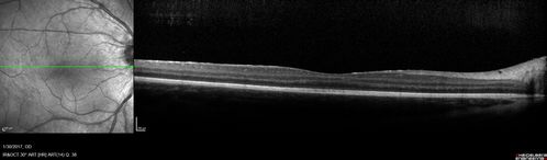 Neuroretinitis - NOT cat scratch - 5 year old
Presented with nerve swelling, serous RD and uveitis.  Ultimately responded to steroids and methotrexate.  ANA is positive.  All other extensive testing negative including MRI worried about MS
