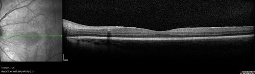 Neuroretinitis - NOT cat scratch - 5 year old
Presented with nerve swelling, serous RD and uveitis.  Ultimately responded to steroids and methotrexate.  ANA is positive.  All other extensive testing negative including MRI worried about MS
