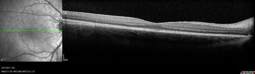 Neuroretinitis - NOT cat scratch - 5 year old
Presented with nerve swelling, serous RD and uveitis.  Ultimately responded to steroids and methotrexate.  ANA is positive.  All other extensive testing negative including MRI worried about MS
