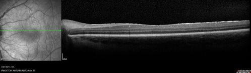 Neuroretinitis - NOT cat scratch - 5 year old
Presented with nerve swelling, serous RD and uveitis.  Ultimately responded to steroids and methotrexate.  ANA is positive.  All other extensive testing negative including MRI worried about MS
