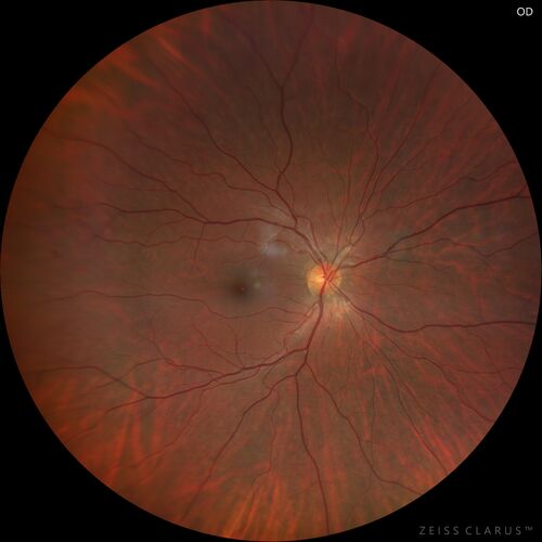 32 year old with peripheral CHRPE
