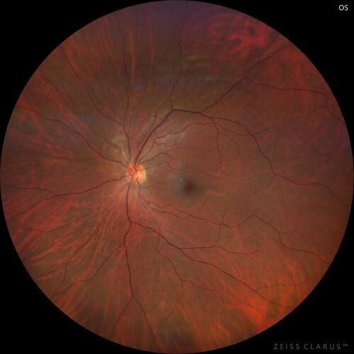 32 year old with peripheral CHRPE
