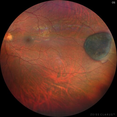 32 year old female with normal vision and CHRPE
