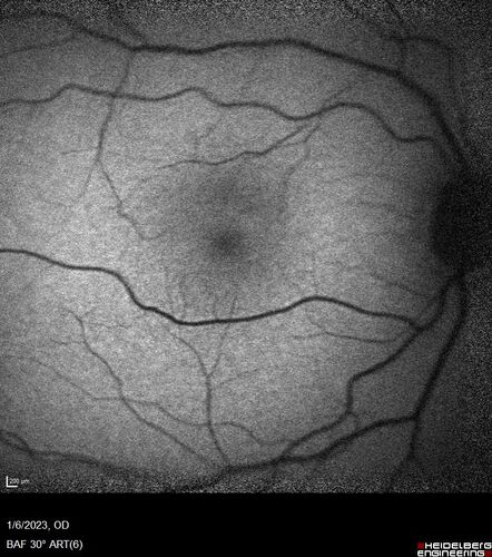 32 year old with peripheral CHRPE
