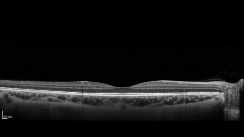 32 year old with peripheral CHRPE
