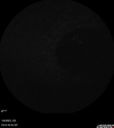 32 year old female with normal vision and CHRPE
