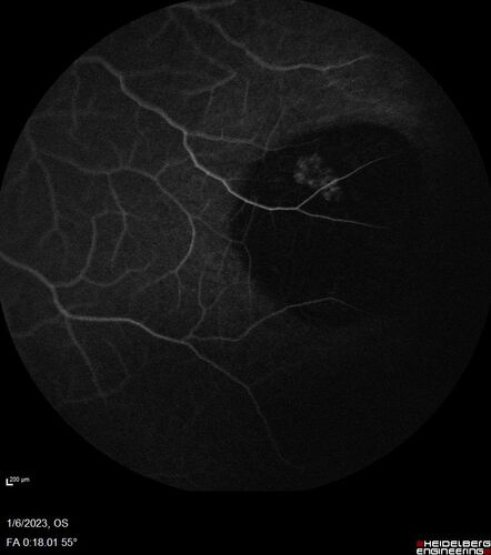 32 year old female with normal vision and CHRPE
