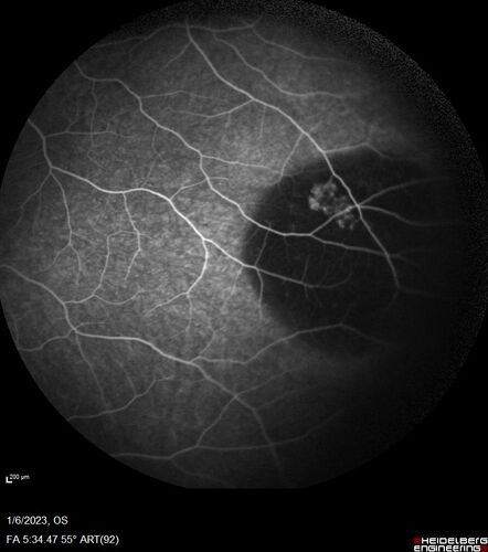 32 year old female with normal vision and CHRPE
