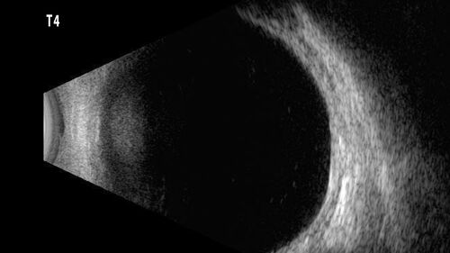 32 year old with peripheral CHRPE
