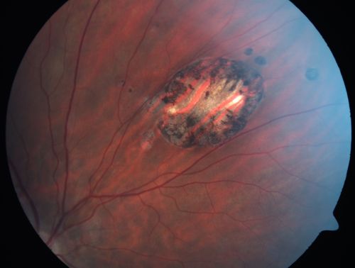 Congenital Hypertrophy of the Retinal Pigment Epithelium CHRPE has Satellite Lesions
