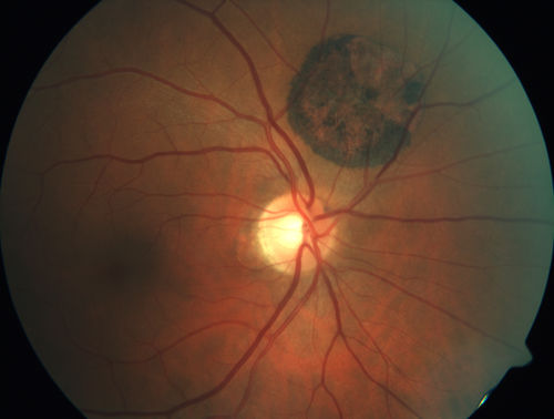 Congenital Hypetrophy of the Retinal Pigment Epithelium (CHRPE)
63 year old female with normal vision and CHRPE lesion in the right eye.
