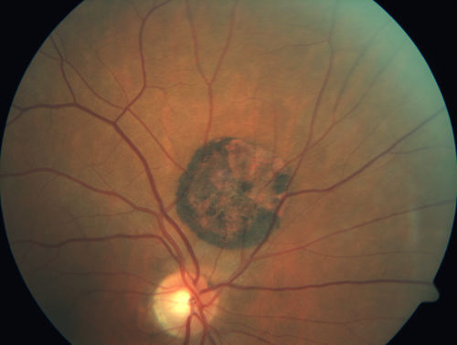 Congenital Hypetrophy of the Retinal Pigment Epithelium (CHRPE)
63 year old female with normal vision and CHRPE lesion in the right eye.
