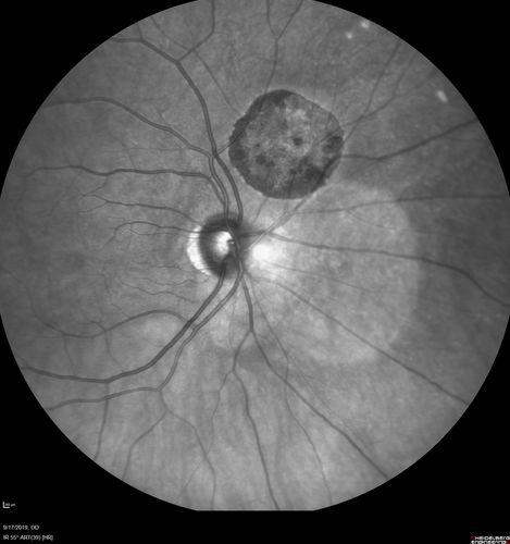 Congenital Hypetrophy of the Retinal Pigment Epithelium (CHRPE)
63 year old female with normal vision and CHRPE lesion in the right eye.
