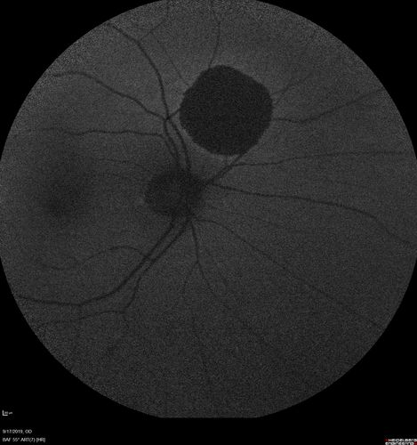 Congenital Hypetrophy of the Retinal Pigment Epithelium (CHRPE)
63 year old female with normal vision and CHRPE lesion in the right eye.
