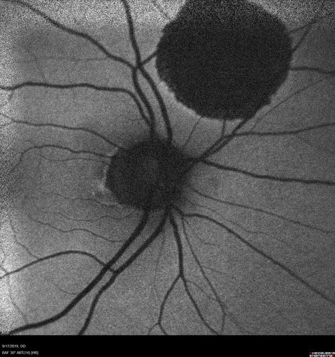 Congenital Hypetrophy of the Retinal Pigment Epithelium (CHRPE)
63 year old female with normal vision and CHRPE lesion in the right eye.

