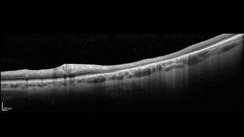 Congenital Hypetrophy of the Retinal Pigment Epithelium (CHRPE)
63 year old female with normal vision and CHRPE lesion in the right eye.
