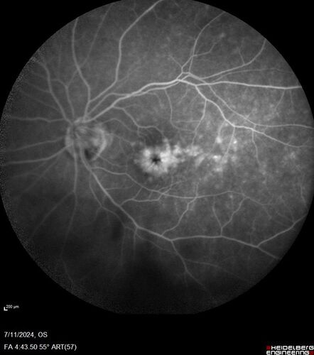 Latanoprost induced CME
89 year old man with CME from latanoprost that cleared within one month of stopping the medication

