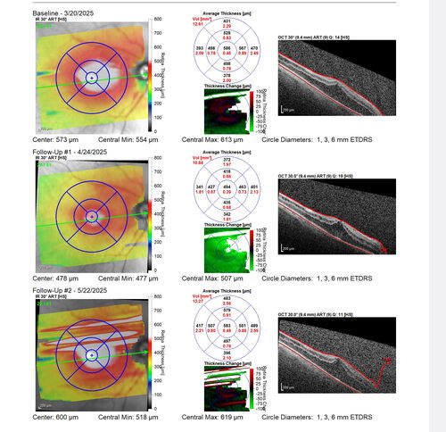 Paclitaxel induced cystoid macular edema - reversed when chemo stopped
74 year old retired physician  About 2-3 weeks ago there was gradual vision loss in the right eye. The patient was seen by an ophthalmologist who saw macular swelling and injected vabysmo. He has been on chemotherapy (Carbiplatin and Carboxytaxol for 2 cancers - advanced prostrate diagnosed 2019 - has had brain surgery AND squamous lung cancers treated with radiation)
Medical Hx: Prostate cancer (Onset: 2018). Pulmonary and bone cancer metastatic. Brain cancer metastasized from prostate cancer. 
Surgical Hx: Right frontal & Frontoparietal Craniotomy (Onset: 2024). Appendectomy. Hemorrhoidectomy. Herniorrhaphy. Prostate. Systemic Meds: Chemotherapy. Radiation. Eligard Every 3 Months 22.5 MG per 0.375 ML Prefilled Syringe. MIRALAX prn. Tums Freshers 500 MG Chewable Tablet. Vitamin D. XGEVA. 
VA OD: Dcc20/125+1 
VA OS: Dcc20/125-2 
TP: OD:12 OS:15
