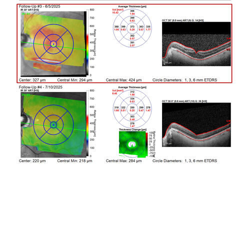 Paclitaxel induced cystoid macular edema - reversed when chemo stopped
74 year old retired physician  About 2-3 weeks ago there was gradual vision loss in the right eye. The patient was seen by an ophthalmologist who saw macular swelling and injected vabysmo. He has been on chemotherapy (Carbiplatin and Carboxytaxol for 2 cancers - advanced prostrate diagnosed 2019 - has had brain surgery AND squamous lung cancers treated with radiation)
Medical Hx: Prostate cancer (Onset: 2018). Pulmonary and bone cancer metastatic. Brain cancer metastasized from prostate cancer. 
Surgical Hx: Right frontal & Frontoparietal Craniotomy (Onset: 2024). Appendectomy. Hemorrhoidectomy. Herniorrhaphy. Prostate. Systemic Meds: Chemotherapy. Radiation. Eligard Every 3 Months 22.5 MG per 0.375 ML Prefilled Syringe. MIRALAX prn. Tums Freshers 500 MG Chewable Tablet. Vitamin D. XGEVA. 
VA OD: Dcc20/125+1 
VA OS: Dcc20/125-2 
TP: OD:12 OS:15
