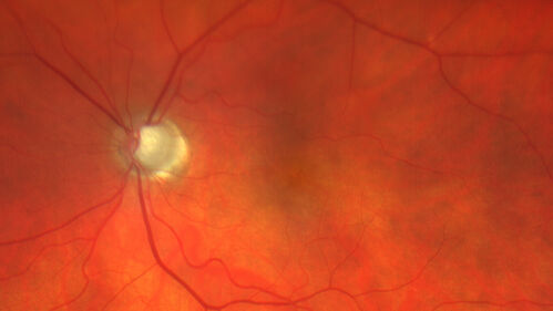Paclitaxel induced cystoid macular edema - reversed when chemo stopped
74 year old retired physician  About 2-3 weeks ago there was gradual vision loss in the right eye. The patient was seen by an ophthalmologist who saw macular swelling and injected vabysmo. He has been on chemotherapy (Carbiplatin and Carboxytaxol for 2 cancers - advanced prostrate diagnosed 2019 - has had brain surgery AND squamous lung cancers treated with radiation)
Medical Hx: Prostate cancer (Onset: 2018). Pulmonary and bone cancer metastatic. Brain cancer metastasized from prostate cancer. 
Surgical Hx: Right frontal & Frontoparietal Craniotomy (Onset: 2024). Appendectomy. Hemorrhoidectomy. Herniorrhaphy. Prostate. Systemic Meds: Chemotherapy. Radiation. Eligard Every 3 Months 22.5 MG per 0.375 ML Prefilled Syringe. MIRALAX prn. Tums Freshers 500 MG Chewable Tablet. Vitamin D. XGEVA. 
VA OD: Dcc20/125+1 
VA OS: Dcc20/125-2 
TP: OD:12 OS:15
