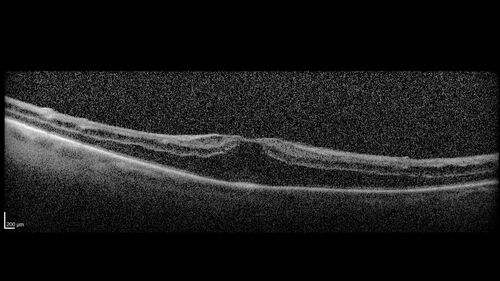 Paclitaxel induced cystoid macular edema - reversed when chemo stopped
74 year old retired physician  About 2-3 weeks ago there was gradual vision loss in the right eye. The patient was seen by an ophthalmologist who saw macular swelling and injected vabysmo. He has been on chemotherapy (Carbiplatin and Carboxytaxol for 2 cancers - advanced prostrate diagnosed 2019 - has had brain surgery AND squamous lung cancers treated with radiation)
Medical Hx: Prostate cancer (Onset: 2018). Pulmonary and bone cancer metastatic. Brain cancer metastasized from prostate cancer. 
Surgical Hx: Right frontal & Frontoparietal Craniotomy (Onset: 2024). Appendectomy. Hemorrhoidectomy. Herniorrhaphy. Prostate. Systemic Meds: Chemotherapy. Radiation. Eligard Every 3 Months 22.5 MG per 0.375 ML Prefilled Syringe. MIRALAX prn. Tums Freshers 500 MG Chewable Tablet. Vitamin D. XGEVA. 
VA OD: Dcc20/125+1 
VA OS: Dcc20/125-2 
TP: OD:12 OS:15
