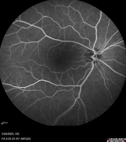 Paclitaxel induced cystoid macular edema - reversed when chemo stopped
74 year old retired physician  About 2-3 weeks ago there was gradual vision loss in the right eye. The patient was seen by an ophthalmologist who saw macular swelling and injected vabysmo. He has been on chemotherapy (Carbiplatin and Carboxytaxol for 2 cancers - advanced prostrate diagnosed 2019 - has had brain surgery AND squamous lung cancers treated with radiation)
Medical Hx: Prostate cancer (Onset: 2018). Pulmonary and bone cancer metastatic. Brain cancer metastasized from prostate cancer. 
Surgical Hx: Right frontal & Frontoparietal Craniotomy (Onset: 2024). Appendectomy. Hemorrhoidectomy. Herniorrhaphy. Prostate. Systemic Meds: Chemotherapy. Radiation. Eligard Every 3 Months 22.5 MG per 0.375 ML Prefilled Syringe. MIRALAX prn. Tums Freshers 500 MG Chewable Tablet. Vitamin D. XGEVA. 
VA OD: Dcc20/125+1 
VA OS: Dcc20/125-2 
TP: OD:12 OS:15
