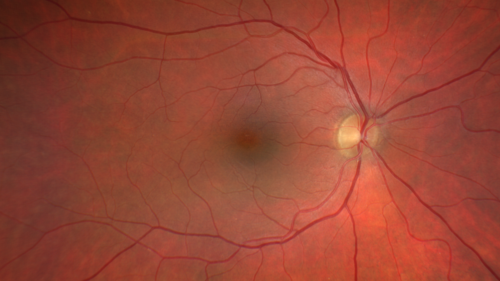 Normal Eye - Vision 20/16
61 year old female with multiple problems including chronic CME in the left eye.
