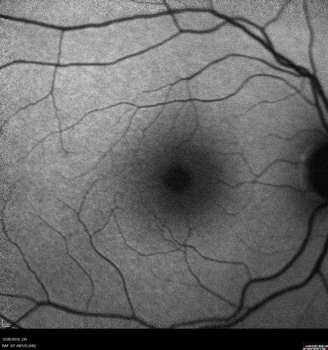 Normal Eye - Vision 20/16
61 year old female with multiple problems including chronic CME in the left eye.
