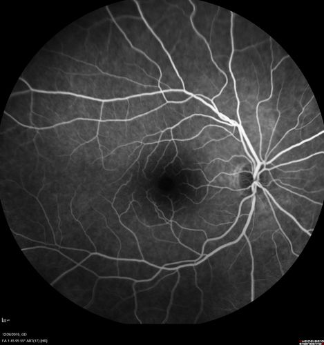 Normal Eye - Vision 20/16
61 year old female with multiple problems including chronic CME in the left eye.
