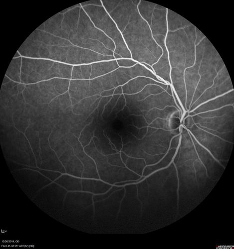 Normal Eye - Vision 20/16
61 year old female with multiple problems including chronic CME in the left eye.
