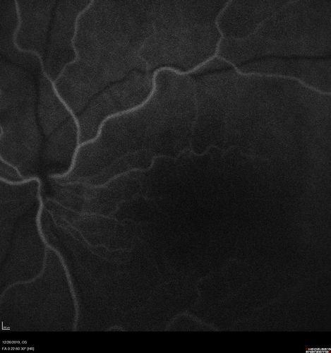 Cystoid Macular Edema and Macular Pucker
has been particular bad for 3 years.  She has a macular pucker and severe CME.

VA 20/160 left eye
