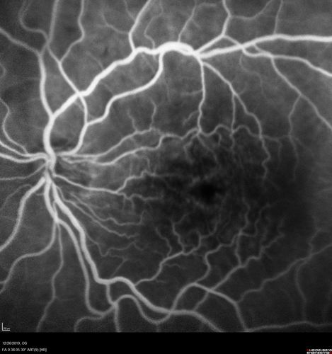 Cystoid Macular Edema and Macular Pucker
has been particular bad for 3 years.  She has a macular pucker and severe CME.

VA 20/160 left eye
